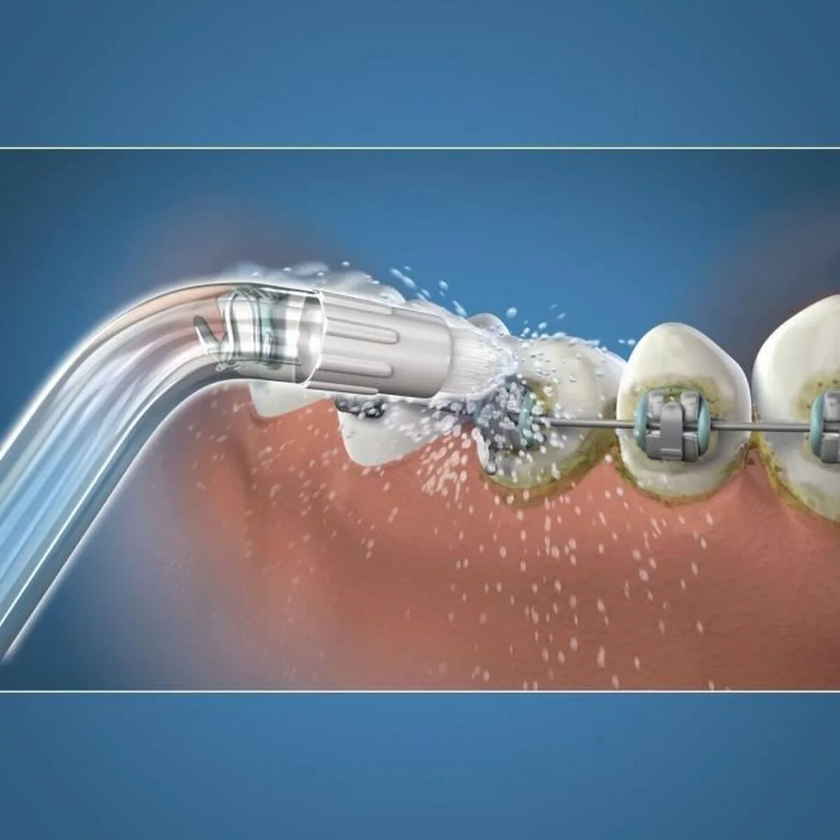 Tete de rechange waterpik od 100e s7101237551. Nous croyons en la magie des objets. Chez Diaytar, chaque produit a le pouvoir de transformer une routine en moment précieux.